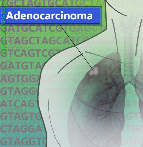 Drawing of adenocarcinoma