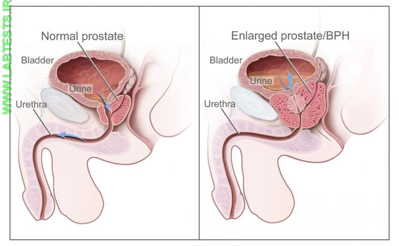 Drawings of normal prostate and enlarged prostate in BPH
