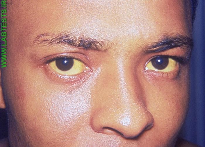 Yellowing of the whites of the eyes (jaundice)