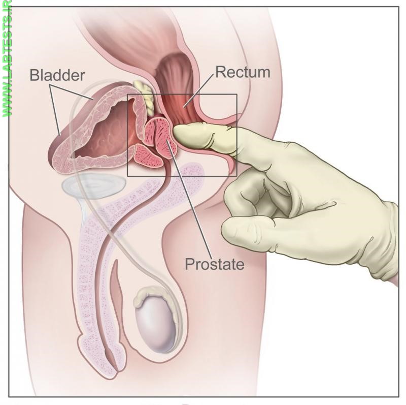 Drawing of a digital rectal exam