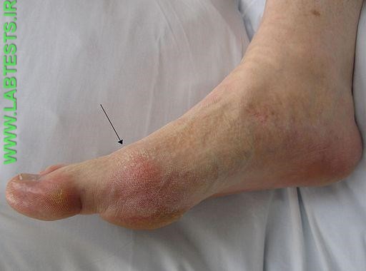 Image of Gout presenting in the metatarsal-phalangeal joint of the big toe