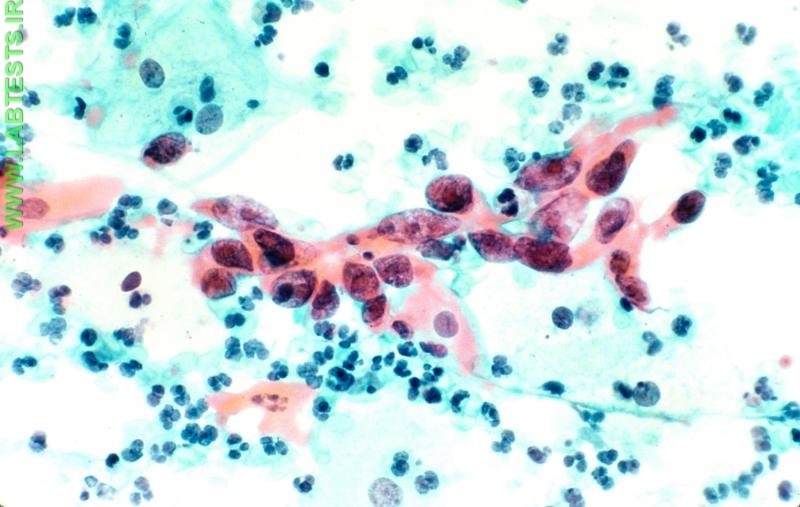 Image of cervical cancer cells