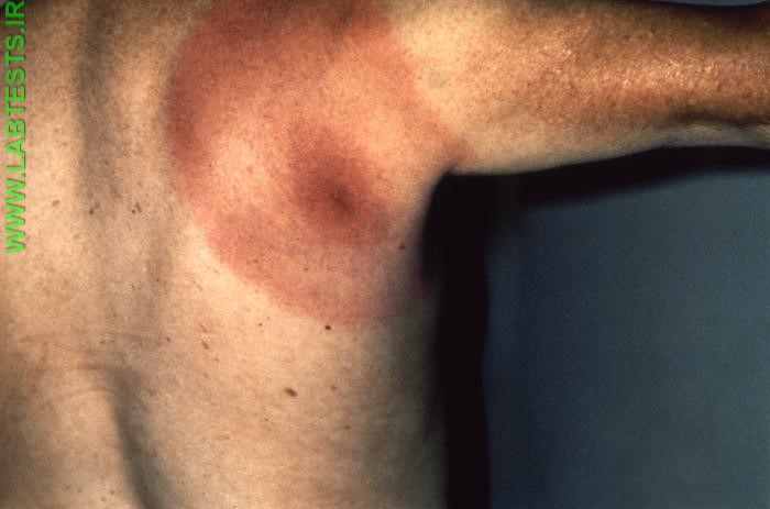 Man with bulls-eye rash cause by Lyme disease