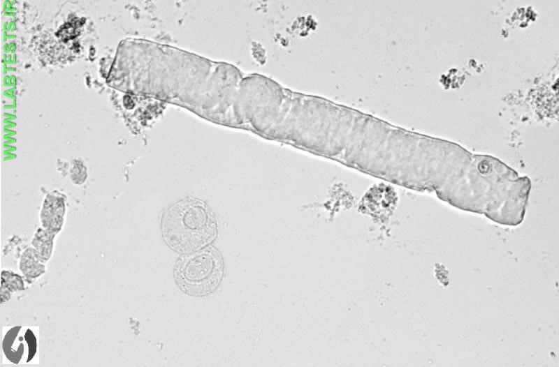 Hyaline casts seen in urine under a microscope
