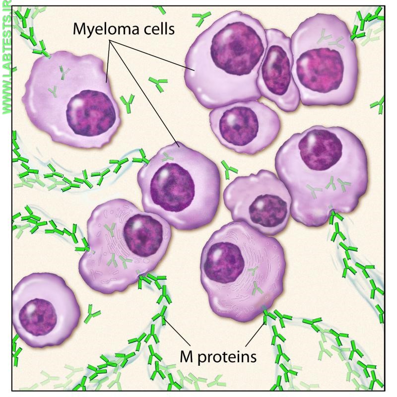 Drawing of multiple myeloma cells