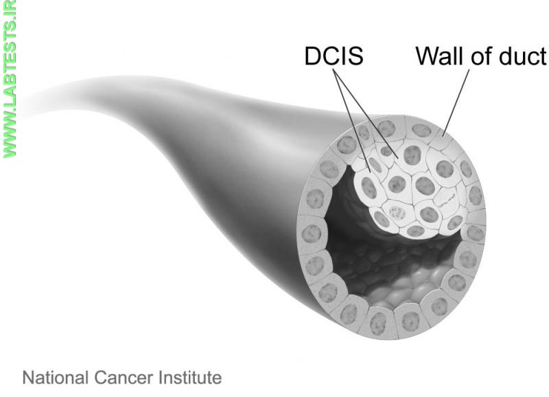 Drawing of breast cancer ductal carcinoma in situ