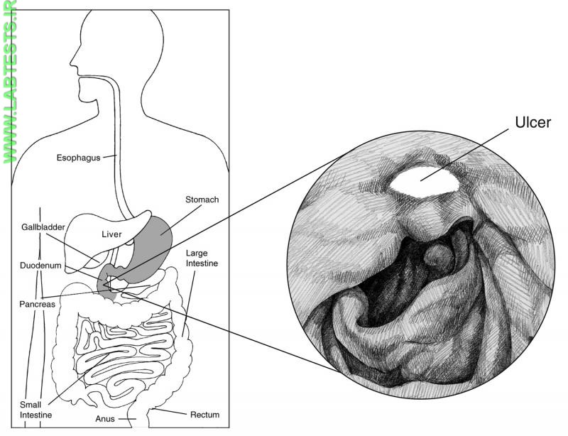 Drawing of peptic ulcer
