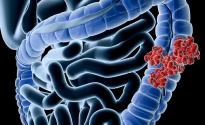 colon cancer