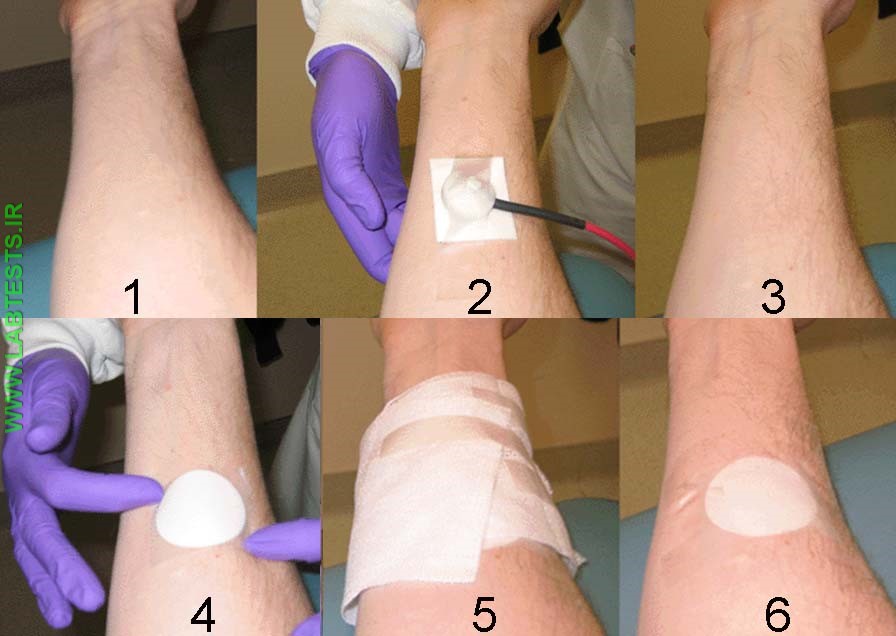 Images of sweat chloride sample collection procedure