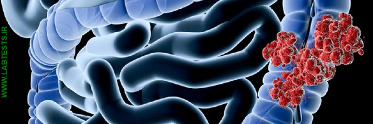 colon cancer