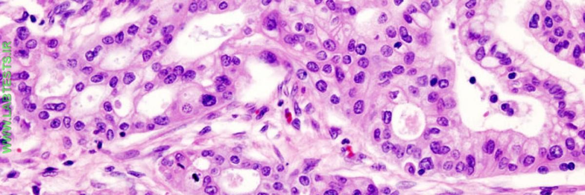 Pancreas adenocarcinoma