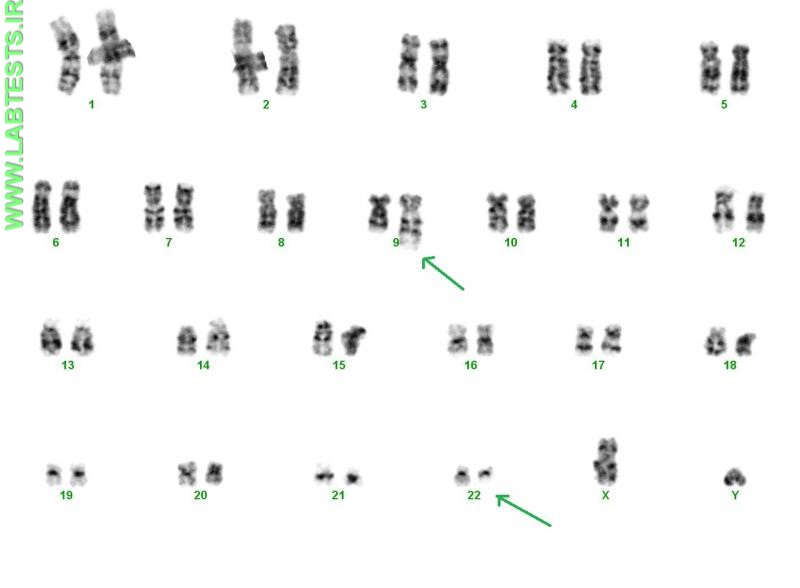 Photo of abnormal karyotype with 9:22 translocation