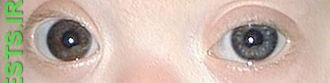 Eyes of baby with Down Syndrome