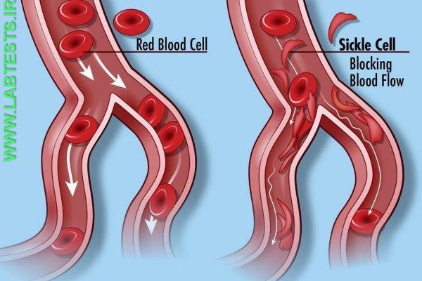 Diagram of sickle cell within blood vessels