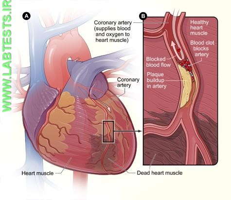 Heart muscle with damage