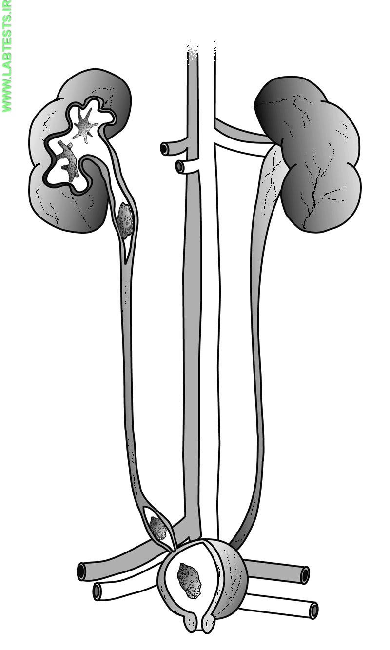Drawing of the urinary tract with kidney stones in kidney, ureter, and bladder  