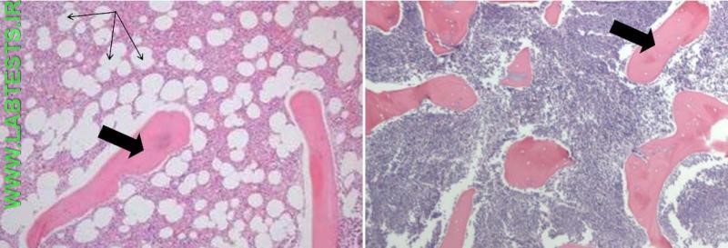 Bone marrow biopsy