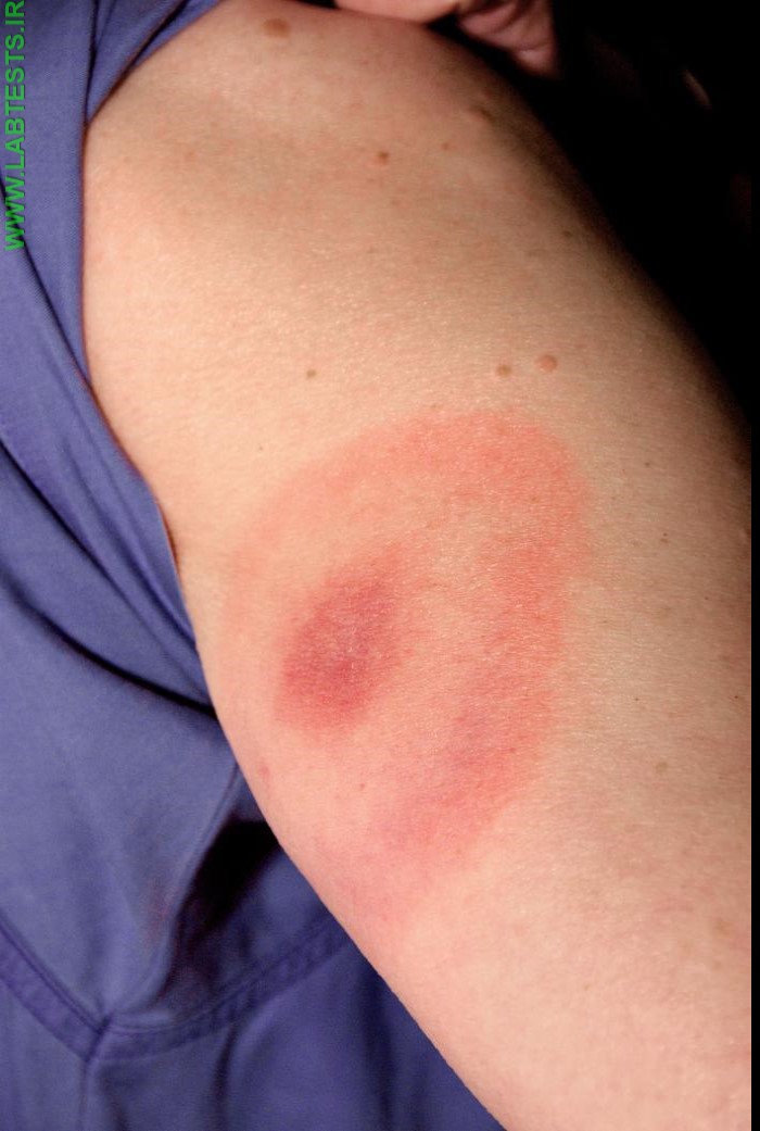 Characteristic rash of Lyme disease