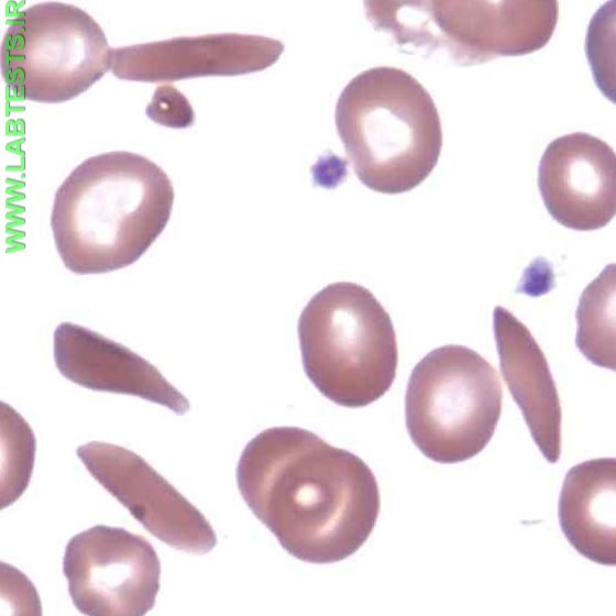 Photo of sickled red blood cells on a slide