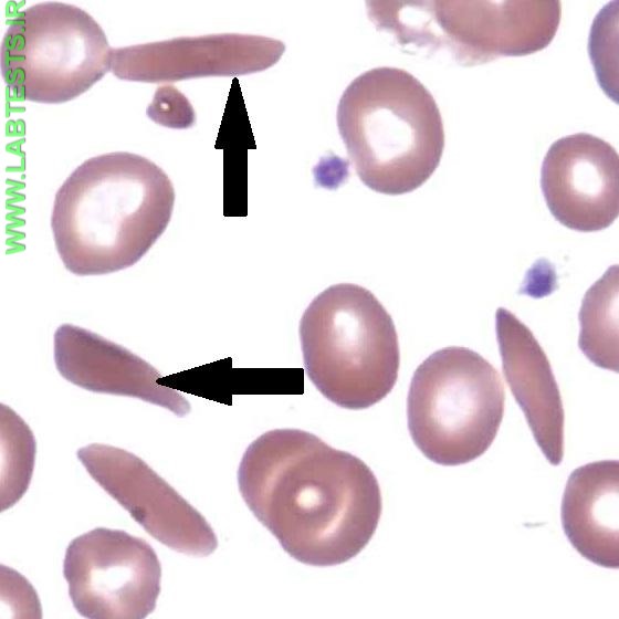 Photo of sickeled red blood cells.
