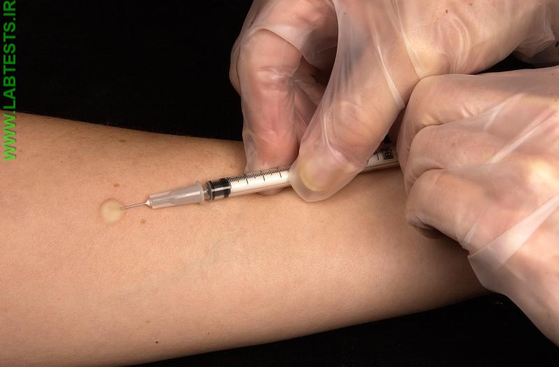Photo of TB skin test