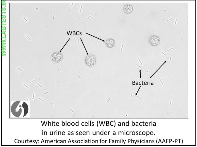 White blood cells and bacteria in urine