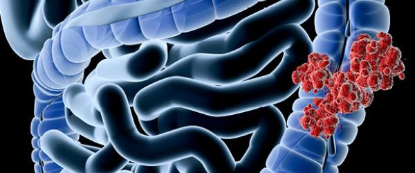 colon cancer